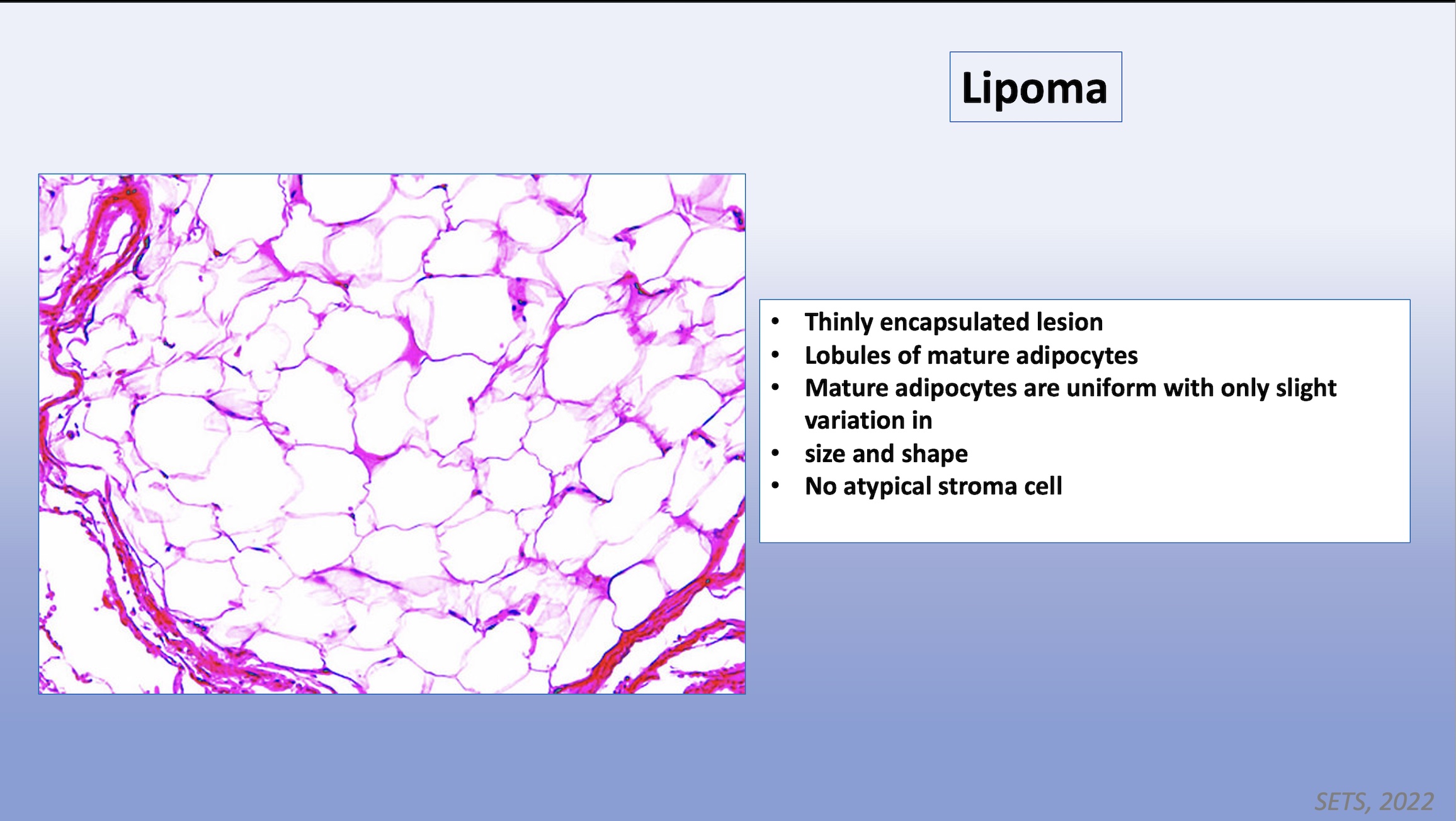 lipoma