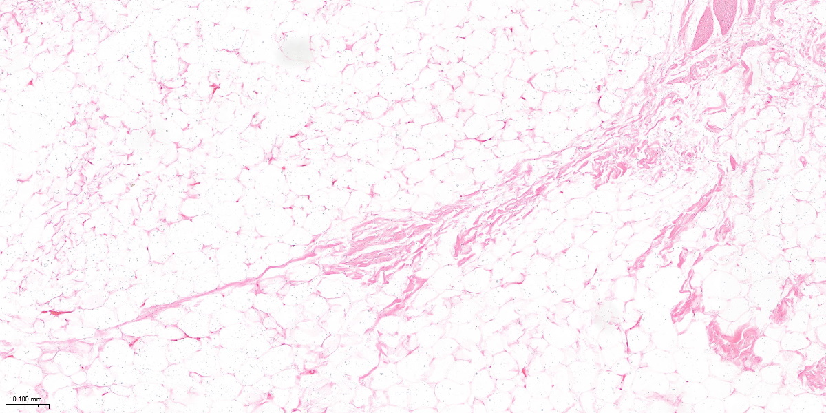 P1030 21 10.0x lipoma