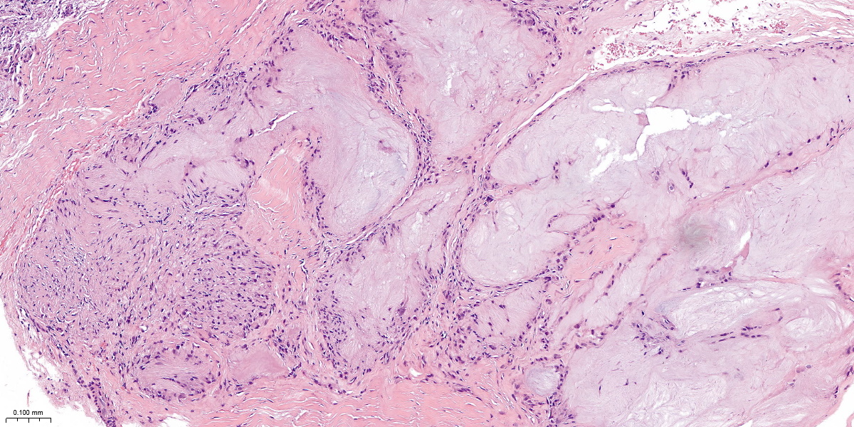 U177 24 10.0x gouty arthritis