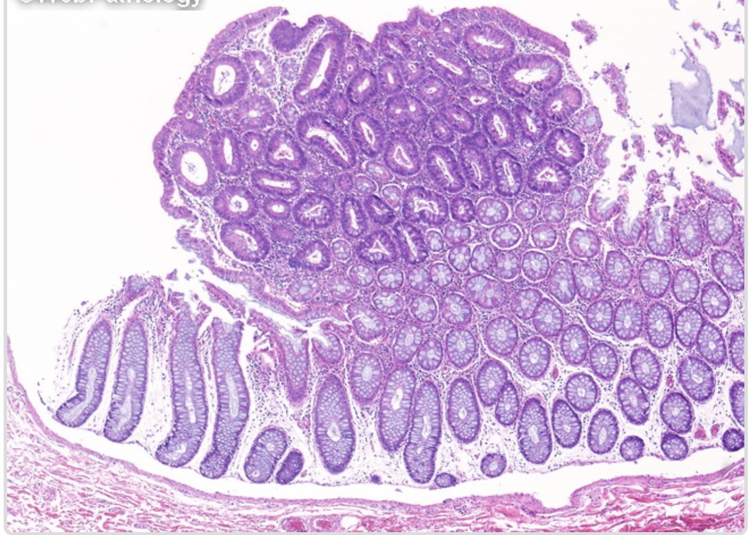 tubular adenoma